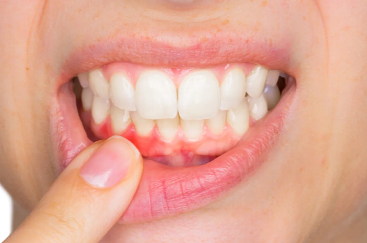 Gum Treatment