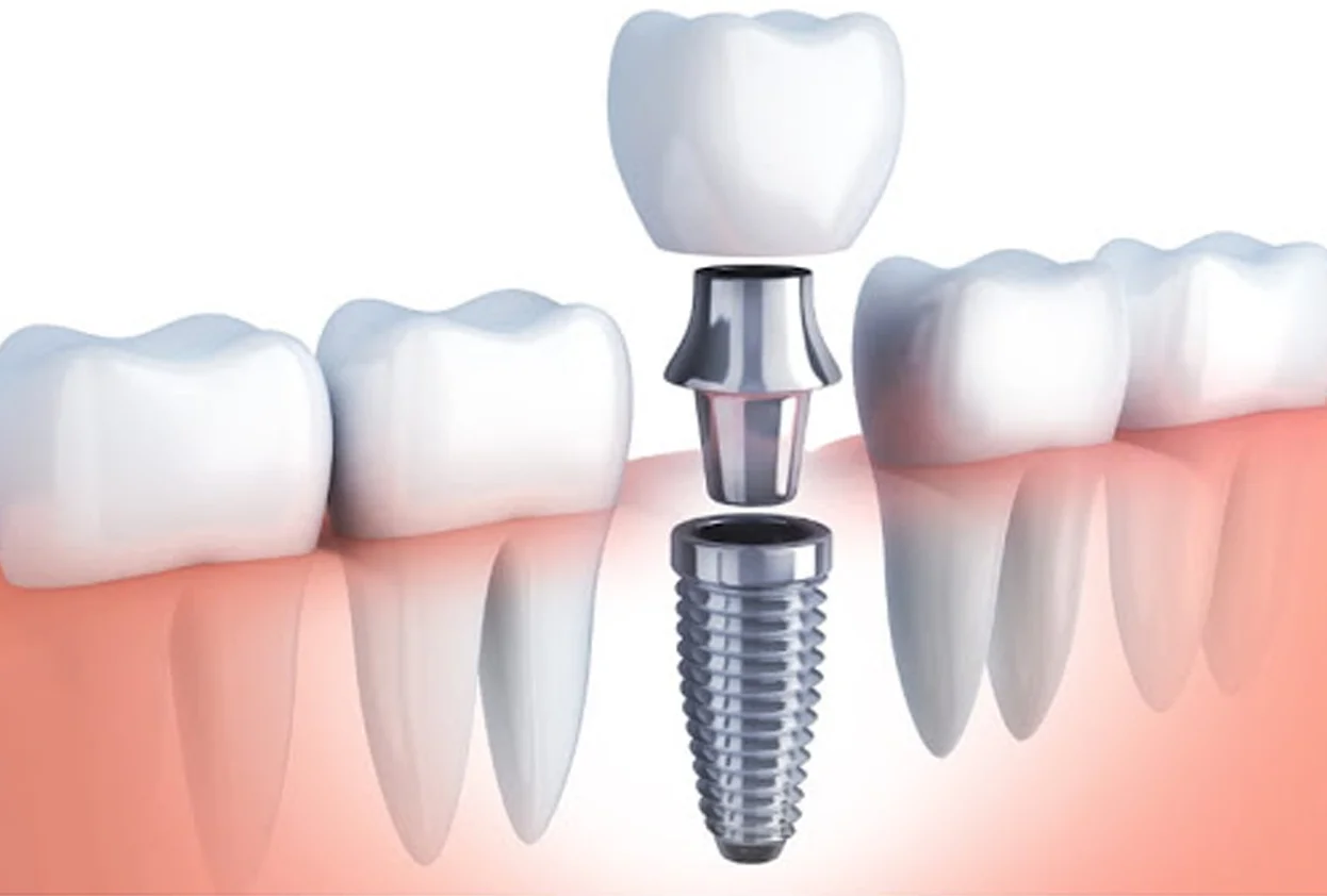 Dental Implant